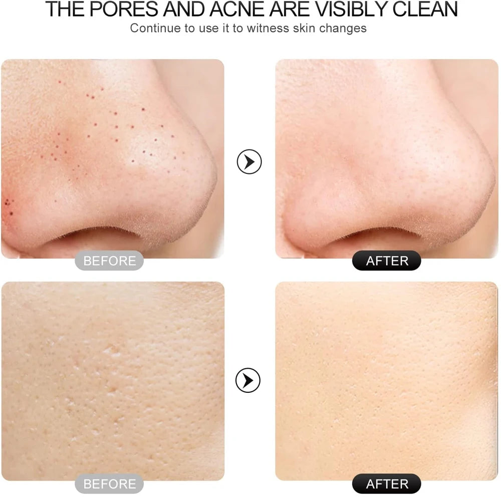 Electric Skin Scrubber Peeling Blackhead Remover Deep Face Cleaning Lifting Ion Acne Pore Cleaner Facial Spatula Shovel Cleanser